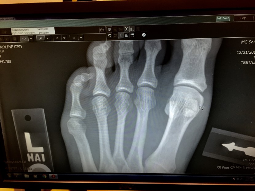 broken sesamoid :-(