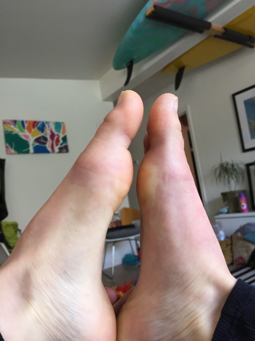 Swollen Left foot. 